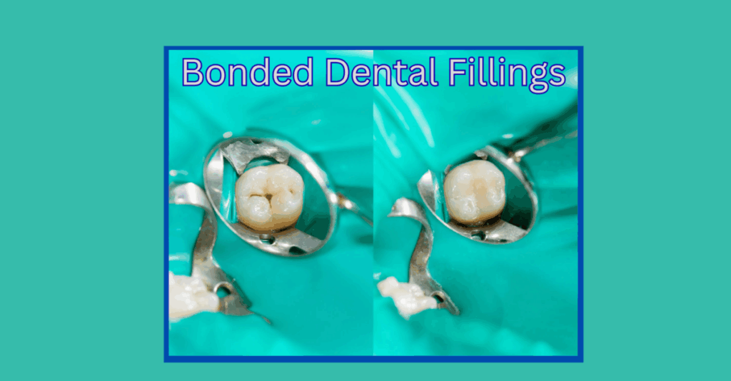 Bonded dental fillings
