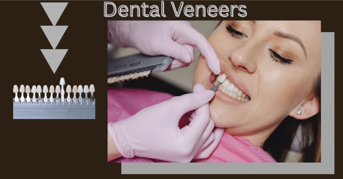 Dental Veneers