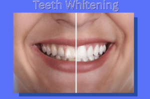 teeth whitening before and after