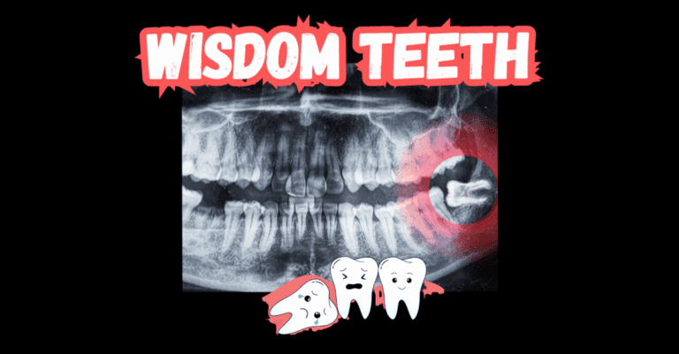 wisdom teeth removal