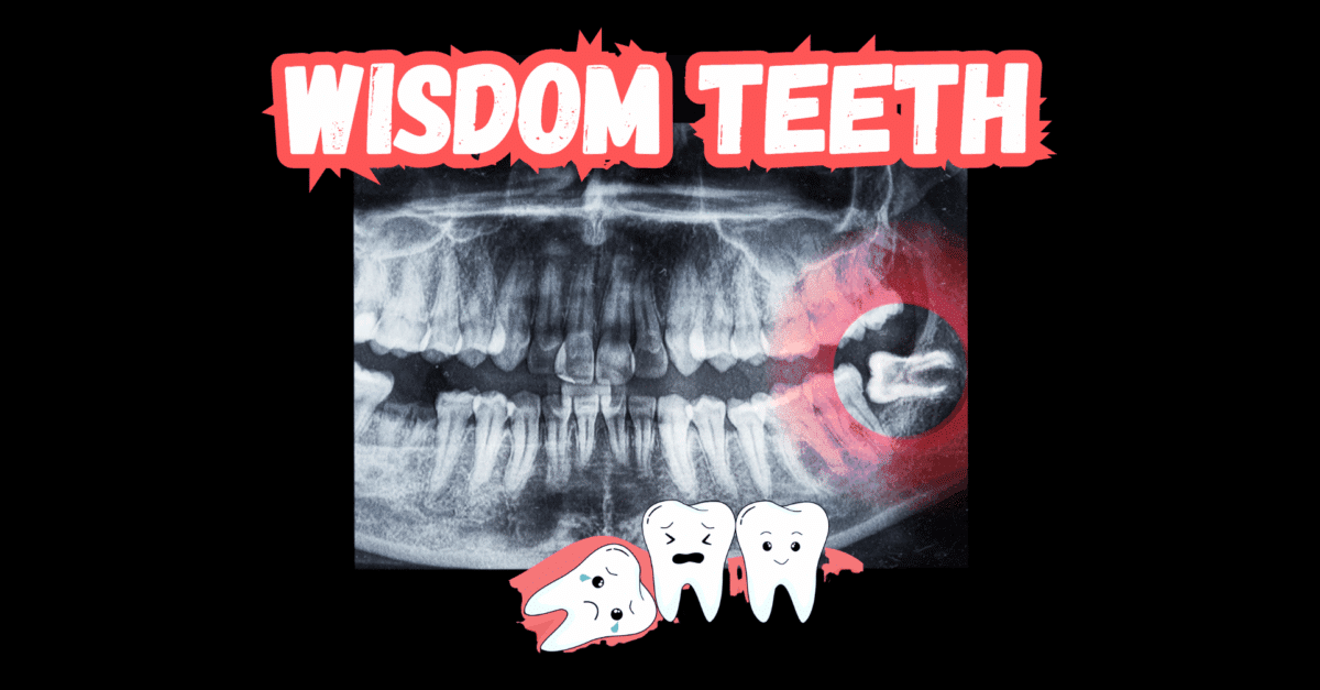 wisdom teeth removal
