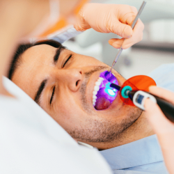 dental sealants being light cured
